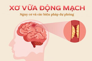 Xơ vữa động mạch: Nguy cơ và các biện pháp dự phòng