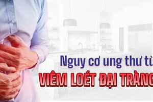 Nguy cơ ung thư từ viêm loét đại tràng: Chớ chủ quan!