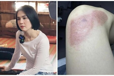 Ngọc Trinh tiết lộ tình trạng vết thương sau 5 tháng gặp tai nạn lái xe mô tô
