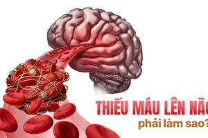 Giải đáp ngay: Thiếu máu lên não phải làm sao?