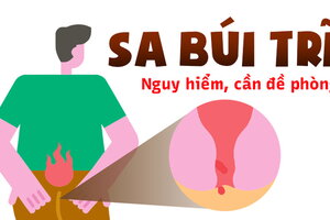 Sa búi trĩ – bệnh tế nhị nhưng nguy hiểm, cần đề phòng