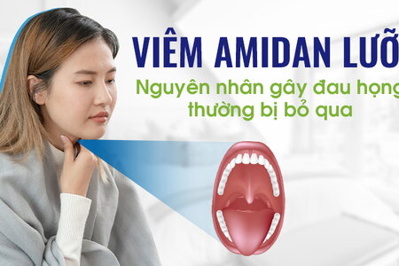 Viêm amidan lưỡi: Nguyên nhân gây đau họng thường bị bỏ qua
