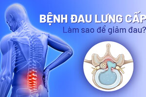 Bệnh đau lưng cấp: Làm sao để giảm nhanh cơn đau dữ dội?