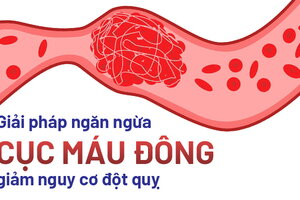 Áp dụng ngay giải pháp ngăn ngừa cục máu đông, giảm nguy cơ đột quỵ