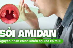 Sỏi amidan: Nguyên nhân chính khiến hơi thở có mùi