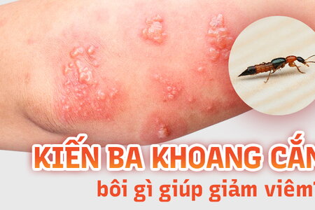 Kiến ba khoang cắn bôi gì giúp giảm viêm, ngăn ngừa sẹo?