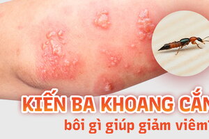 Kiến ba khoang cắn bôi gì giúp giảm viêm, ngăn ngừa sẹo?