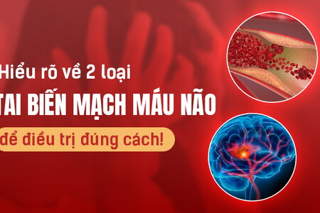 Hiểu rõ về 2 loại tai biến mạch máu não để điều trị đúng cách!