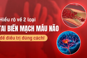 Hiểu rõ về 2 loại tai biến mạch máu não để điều trị đúng cách!