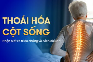 Thoái hóa cột sống: Nhận biết rõ triệu chứng và cách điều trị