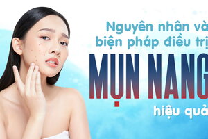 Nguyên nhân và các biện pháp điều trị mụn nang hiệu quả