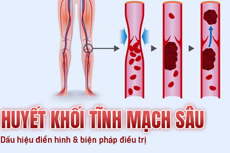 Huyết khối tĩnh mạch sâu Các dấu hiệu điển hình và biện pháp điều trị