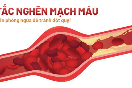 Tắc nghẽn mạch máu – Cần phòng ngừa để tránh đột quỵ!