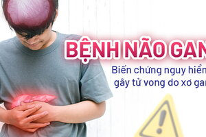 Bệnh não gan: Biến chứng nguy hiểm gây tử vong do xơ gan