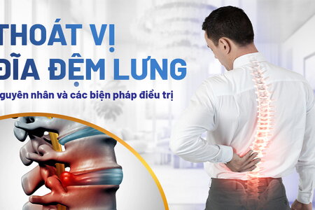 Thoát vị đĩa đệm lưng: Nguyên nhân và các biện pháp điều trị