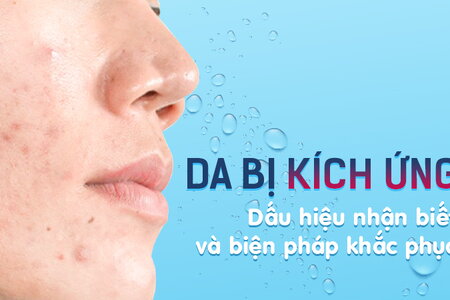 Da bị kích ứng: Dấu hiệu nhận biết và biện pháp khắc phục