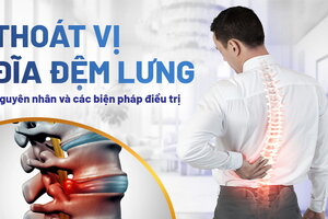 Thoát vị đĩa đệm lưng: Nguyên nhân và các biện pháp điều trị