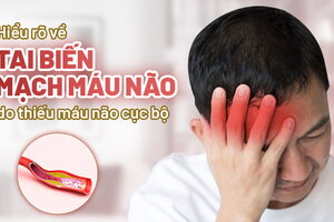 Hiểu rõ về tai biến mạch máu não do thiếu máu não cục bộ