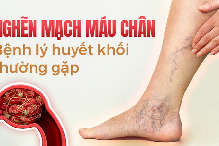 Nghẽn mạch máu chân: Bệnh lý huyết khối thường gặp