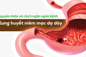 Tìm hiểu nguyên nhân, cách ngăn ngừa bệnh xung huyết niêm mạc dạ dày