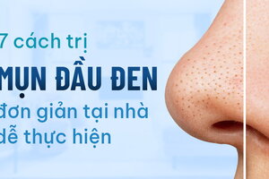 7 cách trị mụn đầu đen đơn giản tại nhà dễ thực hiện