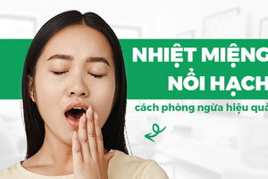 Nhiệt miệng nổi hạch: Chỉ dẫn cách phòng ngừa hiệu quả cao