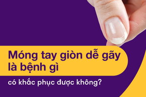 Giải đáp: Móng tay giòn dễ gãy là bệnh gì, có khắc phục được không?