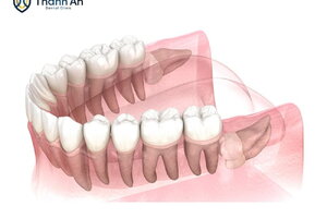 Răng số 8 mọc ngang: Nguy cơ tiềm ẩn và giải pháp xử lý hiệu quả