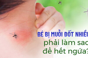 Bé bị muỗi đốt nhiều phải làm sao để hết ngứa?