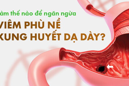 Làm thế nào để ngăn ngừa viêm phù nề xung huyết dạ dày?