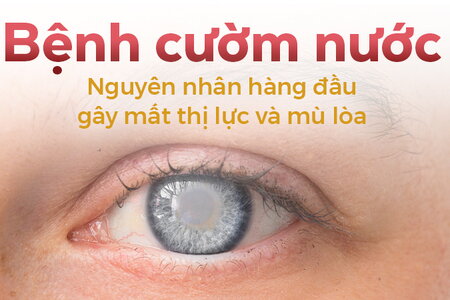 Bệnh cườm nước: Nguyên nhân hàng đầu gây mất thị lực và mù lòa