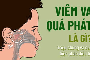 Viêm VA quá phát là gì? Triệu chứng và các biện pháp điều trị