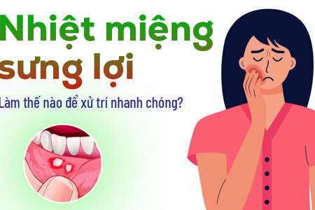 Nhiệt miệng sưng lợi: Làm thế nào để xử trí nhanh chóng?