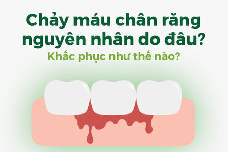 Chảy máu chân răng nguyên nhân do đâu? Khắc phục như thế nào?