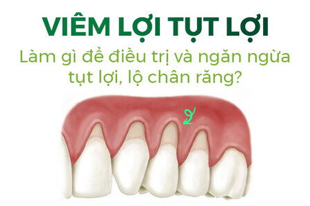 Viêm lợi tụt lợi Làm gì để điều trị và ngăn ngừa tụt lợi lộ chân răng