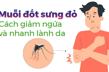 Muỗi đốt sưng đỏ: Cách giảm ngứa và nhanh lành da