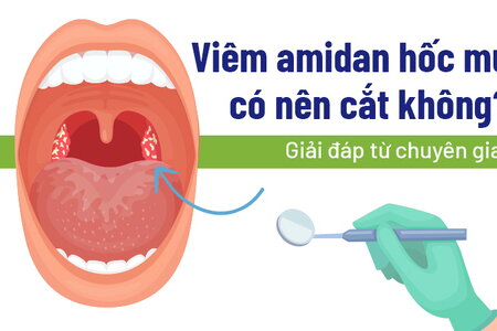 Viêm amidan hốc mủ có nên cắt không: Giải đáp từ chuyên gia