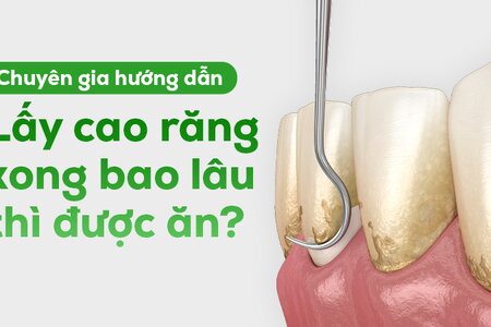 Chuyên gia hướng dẫn: Lấy cao răng xong bao lâu thì được ăn?