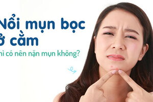 Nổi mụn bọc ở cằm thì có nên nặn mụn không?