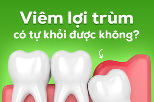 Hỏi nhanh đáp gọn: Viêm lợi trùm có tự khỏi được không?