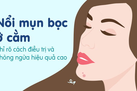 Nổi mụn bọc ở cằm: Chỉ rõ cách điều trị và phòng ngừa hiệu quả cao