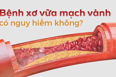 Tư vấn: Bệnh xơ vữa mạch vành có nguy hiểm không?