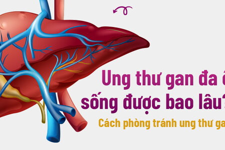 Ung thư gan đa ổ sống được bao lâu? Cách phòng tránh ung thư gan