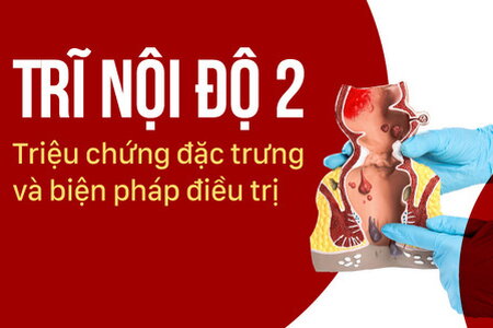 Trĩ nội độ 2: Triệu chứng đặc trưng và biện pháp điều trị