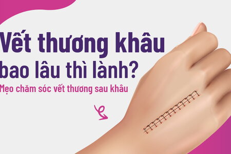 Vết thương khâu bao lâu thì lành? Mẹo chăm sóc vết thương sau khâu