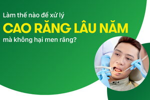 Làm thế nào để xử lý cao răng lâu năm mà không hại men răng?