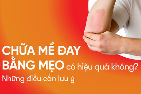 Chữa mề đay bằng mẹo có hiệu quả không? Những điều cần lưu ý