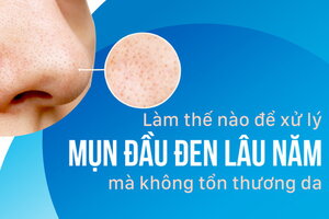 Làm thế nào để xử lý mụn đầu đen lâu năm mà không tổn thương da