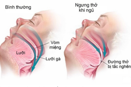 Dấu hiệu cảnh báo hội chứng nguy hiểm ngưng thở khi ngủ