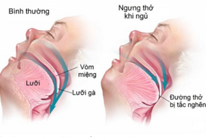 Dấu hiệu cảnh báo hội chứng nguy hiểm ngưng thở khi ngủ